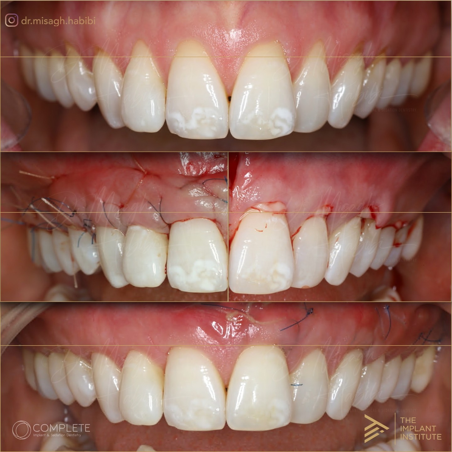Cyst Removal & Jaw Surgery
